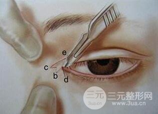 開眼角術(shù)后多久恢復(fù)？會不會留疤？