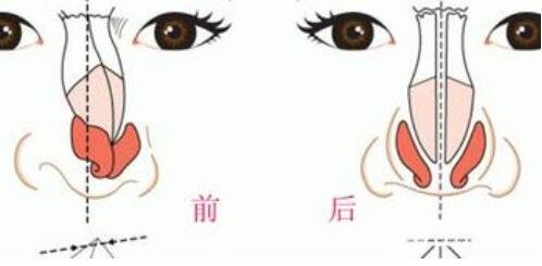 歪鼻矯正的手術(shù)是怎么做的？