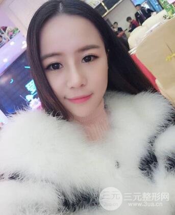 假體隆鼻恢復(fù)過程實例 前后果對比