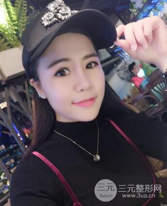 假體隆鼻恢復(fù)過程實例 前后果對比