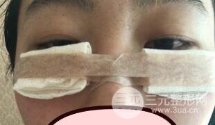 真人內切去眼袋手術過程對比圖片和案例分享
