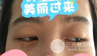 真人內切去眼袋手術過程對比圖片和案例分享