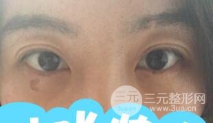 真人內切去眼袋手術過程對比圖片和案例分享