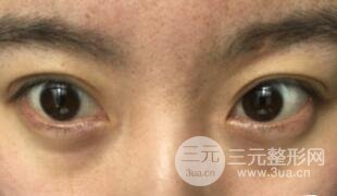 真人內(nèi)切去眼袋手術(shù)過程對比圖片和案例分享