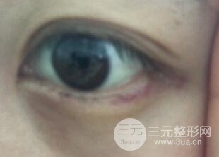 真人內(nèi)切去眼袋手術(shù)過程對比圖片和案例分享