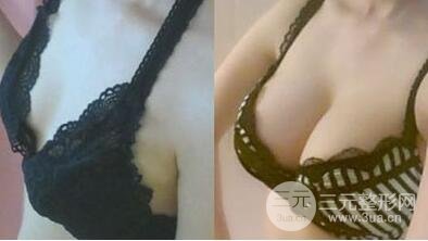 隆胸手術(shù)多少錢?假體隆胸后手感果真實(shí)自然嗎?