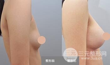 隆胸手術(shù)多少錢?假體隆胸后手感果真實(shí)自然嗎?