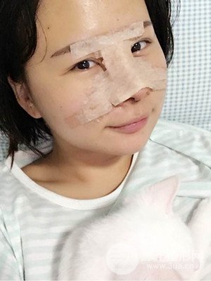廈門思明安黛美邱健欽醫(yī)生給我做的隆鼻整形手術(shù)，大家來看看果怎么樣