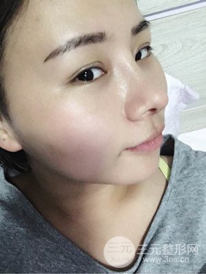 廈門思明安黛美邱健欽醫(yī)生給我做的隆鼻整形手術(shù)，大家來看看果怎么樣