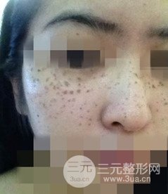 激光祛斑的恢復(fù)過(guò)程，逐步見證自己顏值的逐步提升。