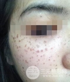 激光祛斑的恢復(fù)過(guò)程，逐步見證自己顏值的逐步提升。