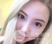 開內眼角和三點定位雙眼皮恢復過程圖片真人案例分享