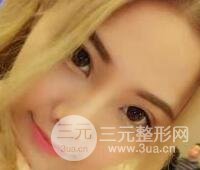 開內眼角和三點定位雙眼皮恢復過程圖片真人案例分享
