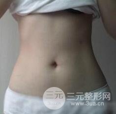 全身吸脂減肥前后對(duì)比圖和恢復(fù)過(guò)程真實(shí)案例分享