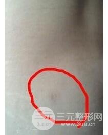全身吸脂減肥前后對(duì)比圖和恢復(fù)過(guò)程真實(shí)案例分享