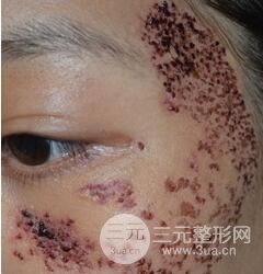 做了三次激光去太田痣，后來的果已經(jīng)是我較為滿意的了。