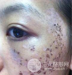 做了三次激光去太田痣，后來的果已經(jīng)是我較為滿意的了。