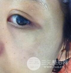 做了三次激光去太田痣，后來的果已經(jīng)是我較為滿意的了。