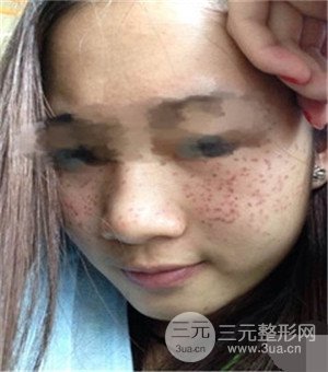 面部美白容整形激光祛斑手術恢復過程