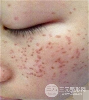 面部美白容整形激光祛斑手術恢復過程