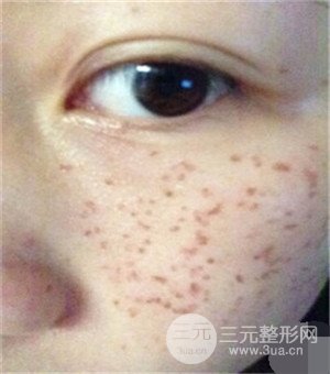 面部美白容整形激光祛斑手術恢復過程