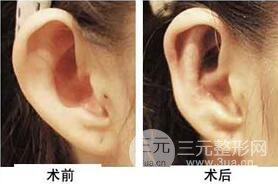 招風耳矯正好不好?會不會留疤?