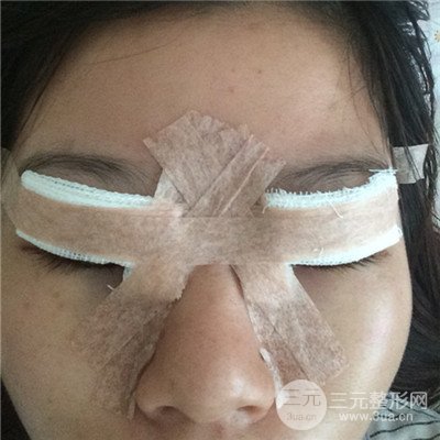濟南曹博士美容醫(yī)院曹景敏眼部綜合整形真人案例分享
