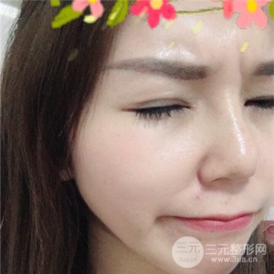 濟南曹博士美容醫(yī)院曹景敏眼部綜合整形真人案例分享