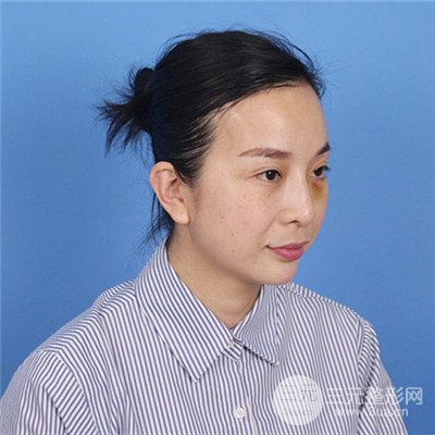 濟南曹博士美容醫(yī)院曹景敏埋埋蛋白線.提升真人案例分享