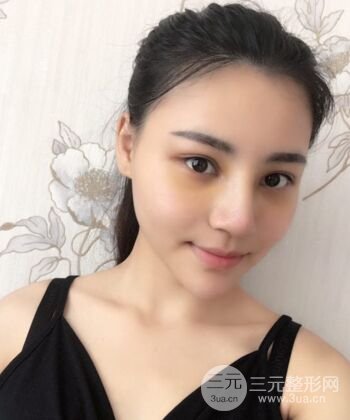 在漢中韓美做了隆鼻整形一個(gè)月，恢復(fù)越來越自然了