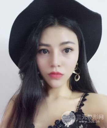 在漢中韓美做了隆鼻整形一個(gè)月，恢復(fù)越來越自然了