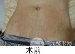 如何去除妊娠紋？做了果酸換膚去妊娠紋果不錯，真人案例圖片分享