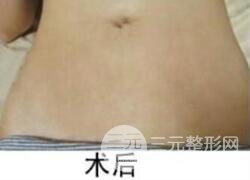 如何去除妊娠紋？做了果酸換膚去妊娠紋果不錯，真人案例圖片分享