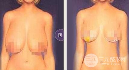 巨大乳房縮小多少錢？成好嗎?巨大乳房縮小對比圖