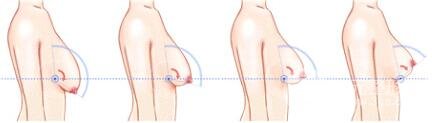 巨大乳房縮小手術(shù)后遺癥有哪些?多少錢(qián)? 巨大乳房縮小果圖