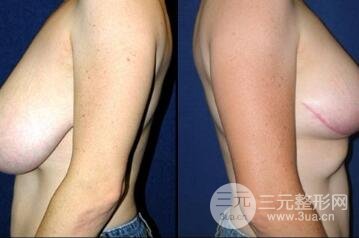 巨大乳房縮小手術(shù)后遺癥有哪些?多少錢(qián)? 巨大乳房縮小果圖