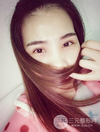 漢中韓美切開雙眼皮開眼角恢復(fù)對比照片