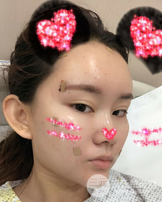 南昌永康自體脂肪面部填充兩個半月果圖