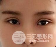 開內(nèi)眼角割雙眼皮案例介紹和恢復(fù)過程圖