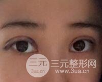 埋線雙眼皮真人案例和十天恢復(fù)圖片日記