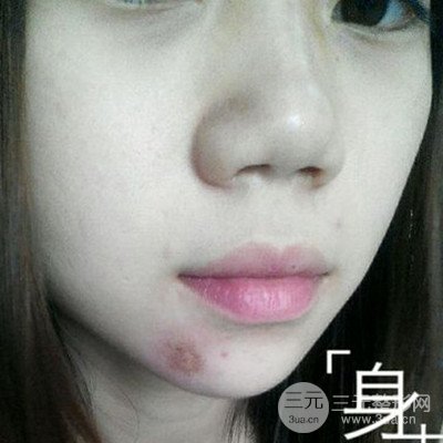 濟南曹博士魯開化激光祛疤真人案例分享