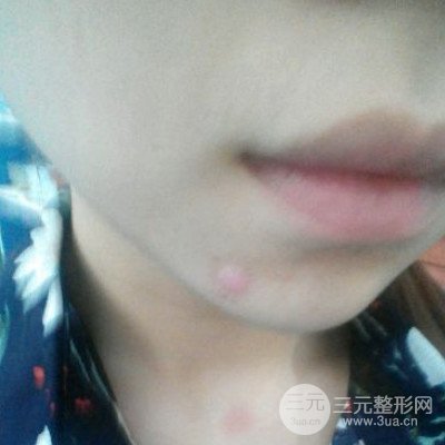 濟南曹博士魯開化激光祛疤真人案例分享