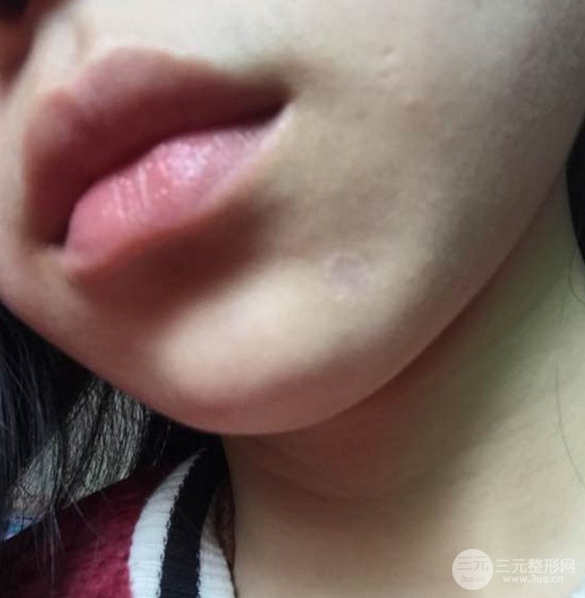 濟南曹博士魯開化激光祛疤真人案例分享