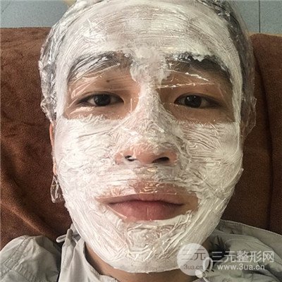 濟南曹博士魯開化祛痘坑痘印真人案例分享