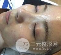 水光補(bǔ)水嫩膚果圖前后對(duì)比和恢復(fù)過(guò)程真實(shí)案例分享
