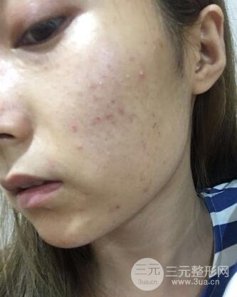 水光補水嫩膚果圖前后對比和恢復(fù)過程真實案例分享