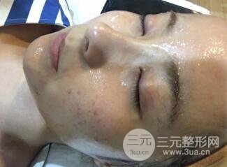 水光補水嫩膚果圖前后對比和恢復(fù)過程真實案例分享