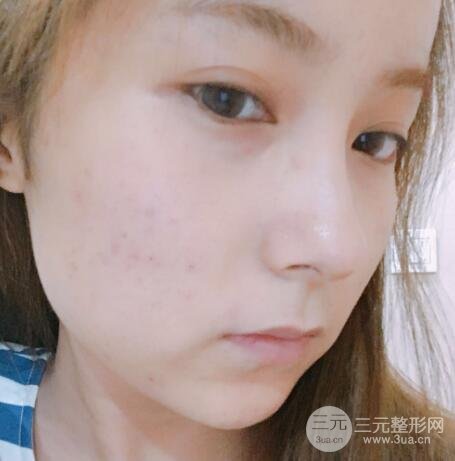 水光補水嫩膚果圖前后對比和恢復(fù)過程真實案例分享