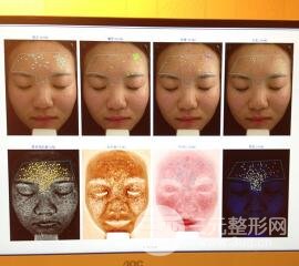 痘坑痘疤要怎么修復(fù)？果酸換膚后臉果圖和真實(shí)案例分享