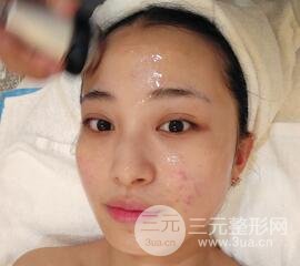 痘坑痘疤要怎么修復(fù)？果酸換膚后臉果圖和真實(shí)案例分享
